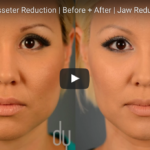 Utilizzo della tossina botulinica nel distretto testa-collo DM_il dentista moderno_Tossina botulinica_botulino_clostridium_neurotossina