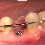 Anchilosi dentale: diagnosi e terapia DM_il dentista moderno_anchilosi dentale