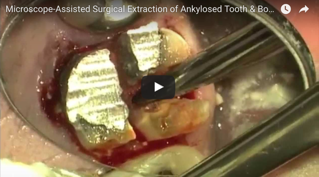 DM_il dentista moderno_anchilosi dentali eziopatogenesi