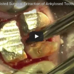 Anchilosi dentale: aspetti eziologici, clinici e terapeutici DM_il dentista moderno_anchilosi dentali eziopatogenesi