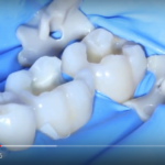 Caratteristiche di riempimento dei compositi in odontoiatria DM_il dentista moderno_resine composite_compositi in odontoiatria