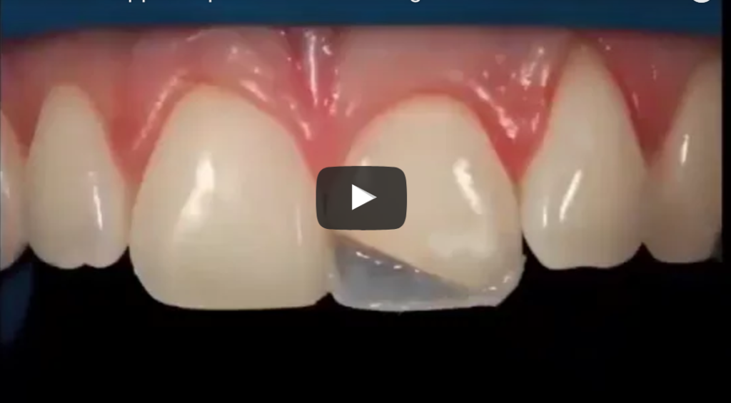 DM_IL DENTISTA MODERNO_Fattori coinvolgenti la polimerizzazione delle resine composite