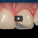 Biochimica e tecnologia della fotopolimerizzazione DM_IL DENTISTA MODERNO_Fattori coinvolgenti la polimerizzazione delle resine composite