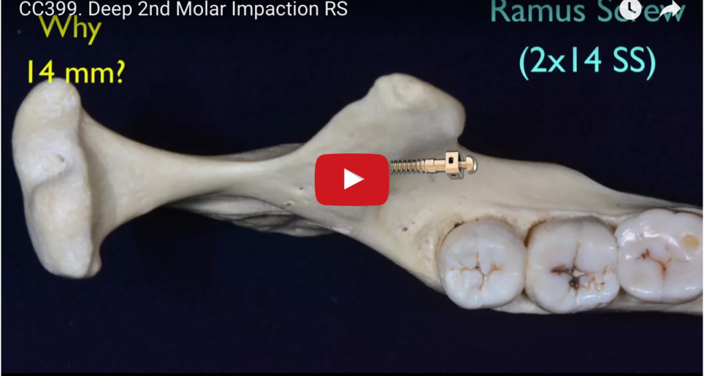 DM_il dentista moderno Trattamento ortodontico del secondo molare incluso
