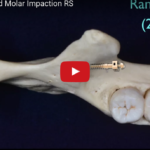 Trattamento ortodontico del secondo molare incluso DM_il dentista moderno Trattamento ortodontico del secondo molare incluso