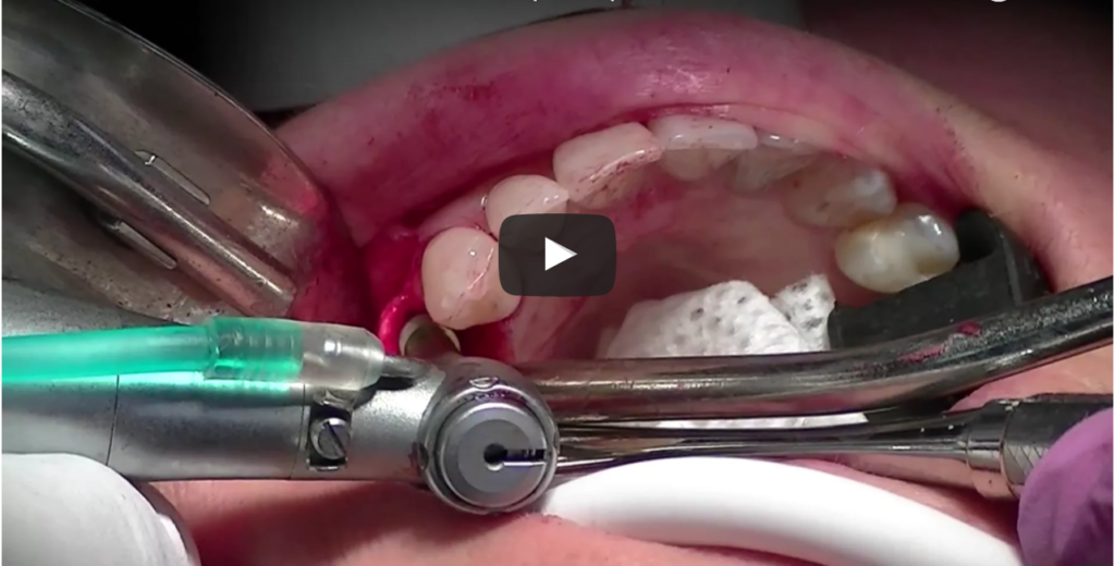 DM_il dentista moderno_Impianti immediati e postestrattivi evidenze scientifiche e raccomandazioni cliniche