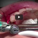 Impianti immediati e postestrattivi: evidenze scientifiche e raccomandazioni cliniche DM_il dentista moderno_Impianti immediati e postestrattivi evidenze scientifiche e raccomandazioni cliniche