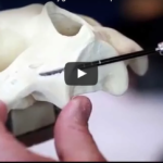 Impianti zigomatici e gravi atrofie dei mascellari DM_il dentista moderno_Impianti zigomatici e gravi atrofie dei mascellari