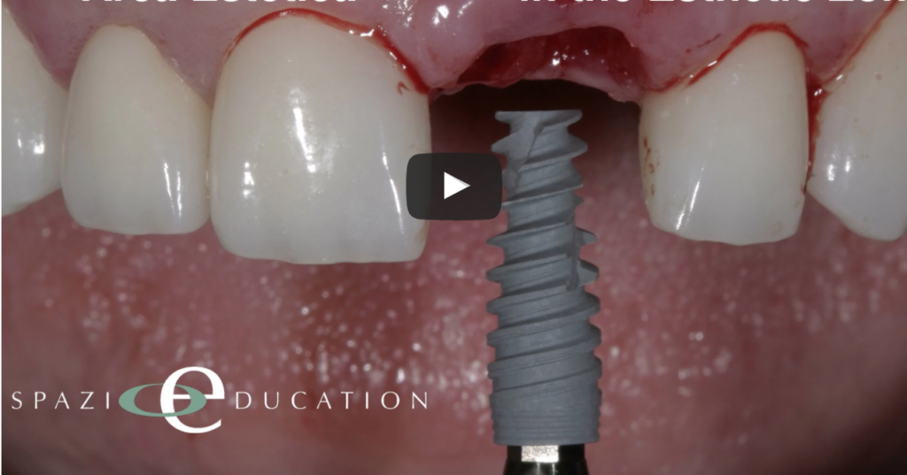DM_il dentista moderno_Posizionamento di impianti post estrattivi evidenze scientifiche