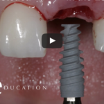 Posizionamento di impianti post estrattivi: evidenze scientifiche DM_il dentista moderno_Posizionamento di impianti post estrattivi evidenze scientifiche