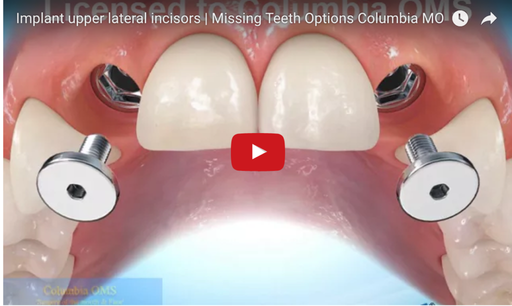 DM_il dentista moderno_agenesie dentarie_implantologia_Chiusura dello spazio con ortodonzia e implantologia negli spazi edentuli