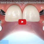 Gestione delle agenesie dentarie ed implantologia nel paziente giovane DM_il dentista moderno_agenesie dentarie_implantologia_Chiusura dello spazio con ortodonzia e implantologia negli spazi edentuli