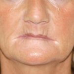 Trattamento dell’affollamento nella dentatura mista