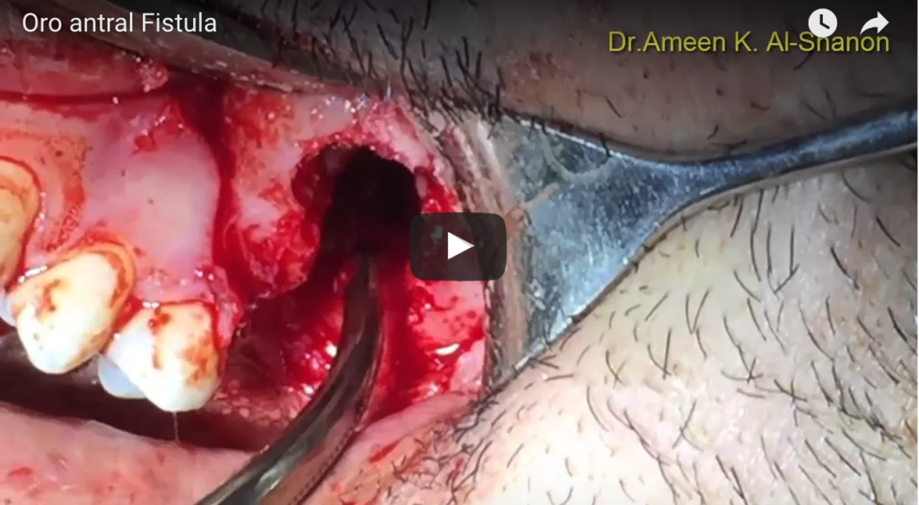 DM_IL DENTISTA MODERNO_ Comunicazioni oro-antrali caratteristiche cliniche e gestione