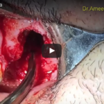 Comunicazioni oro-antrali: caratteristiche cliniche e gestione DM_IL DENTISTA MODERNO_ Comunicazioni oro-antrali caratteristiche cliniche e gestione