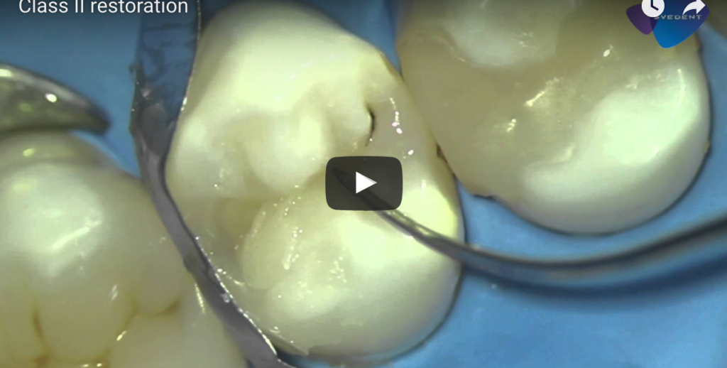 DM_il dentista moderno_Polimerizzazione e fattori che possono influire in odontoiatria restaurativa