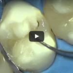 Polimerizzazione e fattori che possono influire in odontoiatria restaurativa DM_il dentista moderno_Polimerizzazione e fattori che possono influire in odontoiatria restaurativa