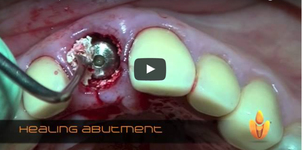 DM_il dentista moderno_Presupposti anatomici degli impianti postestrattivi