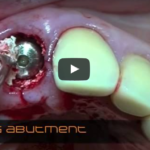 Presupposti anatomici degli impianti postestrattivi DM_il dentista moderno_Presupposti anatomici degli impianti postestrattivi