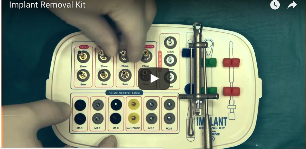 DM_il dentista moderno_Rimozione di impianti dentali falliti tecniche atraumatiche