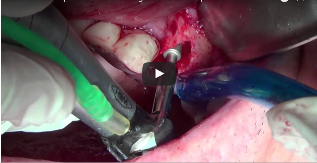 DM_il dentista moderno_Rimozione di impianti falliti tecniche osteotomiche