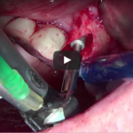 Rimozione di impianti falliti: tecniche osteotomiche DM_il dentista moderno_Rimozione di impianti falliti tecniche osteotomiche