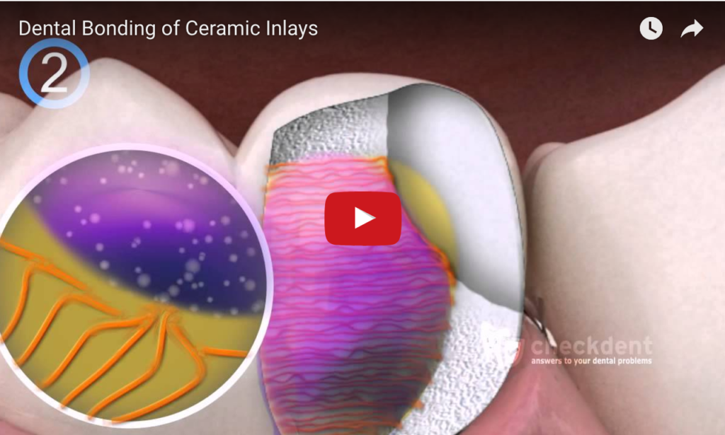 DM_il dentista moderno_Tecniche di adesione chimica e di condizionamento della superficie nelle ceramiche di nuova generazione