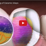 Tecniche di adesione chimica e di condizionamento della superficie nelle ceramiche di nuova generazione DM_il dentista moderno_Tecniche di adesione chimica e di condizionamento della superficie nelle ceramiche di nuova generazione