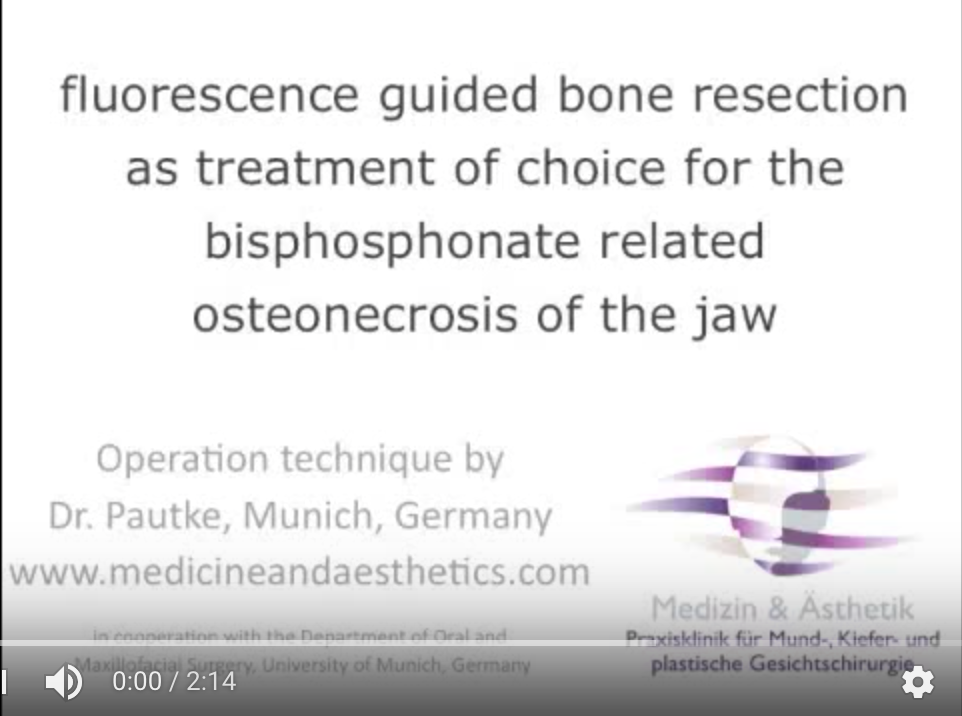 DM_il dentista moderno_Trattamento chirurgico osteonecrosi da bifosfonati