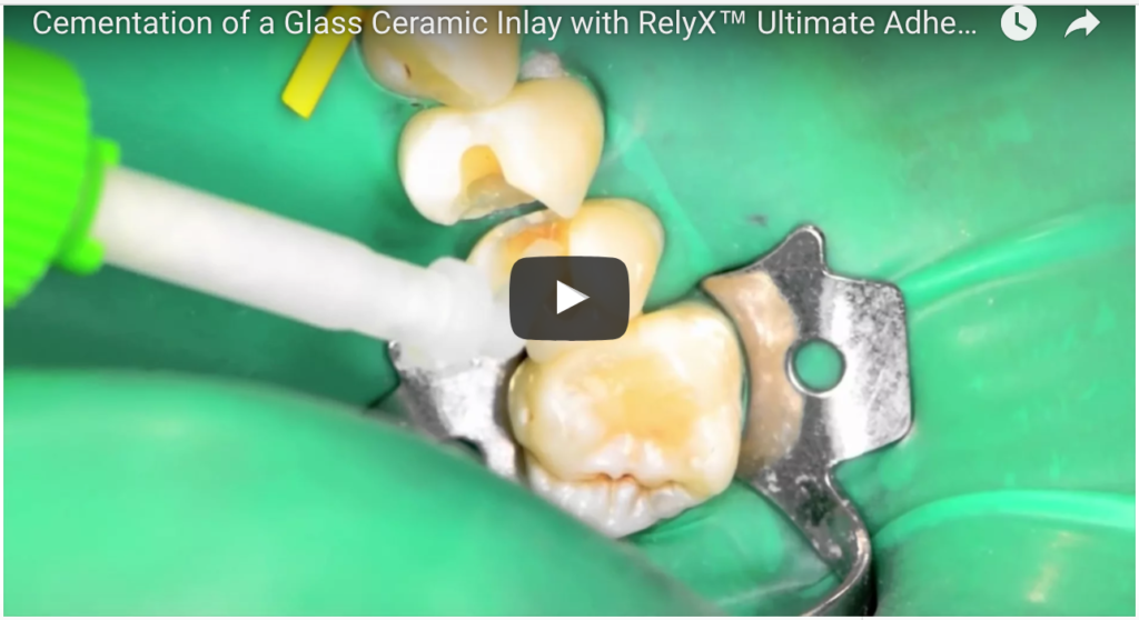 DM_il dentista moderno_restauri indiretti