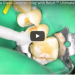 Metodiche per aumentare la ritenzione dei restauri indiretti DM_il dentista moderno_restauri indiretti