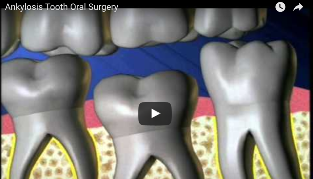 DM_il dentista moderno_Infraocclusione dei molari decidui