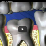 Infraocclusione dei molari decidui DM_il dentista moderno_Infraocclusione dei molari decidui