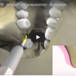 L’utilizzo degli strumenti piezoelettrici nell’allestimento del sito implantare DM_il dentista moderno_L'utilizzo degli strumenti piezoelettrici nell'allestimento del sito implantare