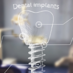 Nuove evidenze sulla gestione dei tessuti molli in implantologia postestrattiva DM_il dentista moderno_Mantenimento dei tessuti molli perimplantari
