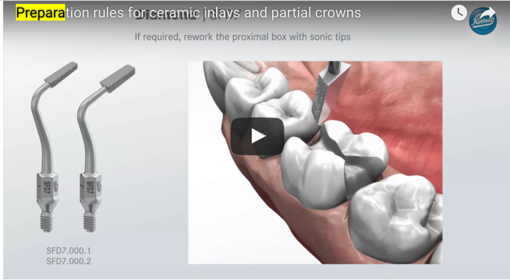 DM_il dentista moderno_intarsi inlay in ceramica_preparazione