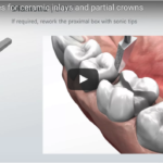 Intarsi inlay in ceramica: criteri di preparazione cavitaria DM_il dentista moderno_intarsi inlay in ceramica_preparazione