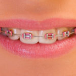 Adesione in ortodonzia: indicazioni di uno studio in vitro DM_il dentista moderno_parodonto_bracket_ortodonzia_legamento parodontale_Short term orthodontics_ortodonzia_incisivo centrale