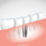 Innesto connettivale e chirurgia implantare: siti donatori Dm_IL DENTISTA MODERNO_impianto_innesto connettivale_subcrestale
