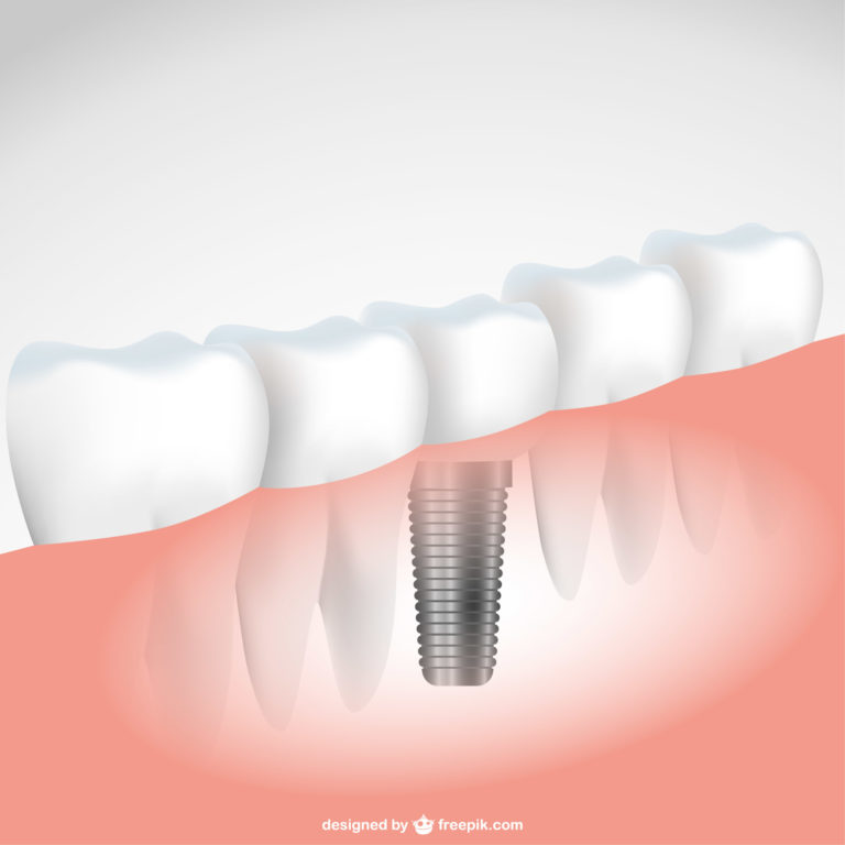 Efficacia dell'inserimento implantare sottocresta