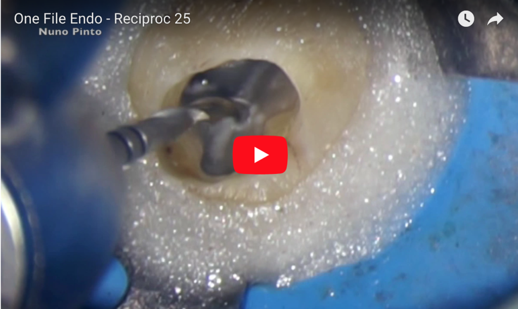 DM_il dentista moderno_movimento reciprocante