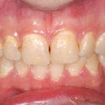 Il trattamento di lesioni cariose non cavitate tramite infiltrazioni di materiali resinosi