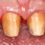 Valutazione clinica della risposta dei tessuti gengivali alla tecnica BOPT