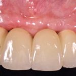 Utilizzo di placche da osteosintesi e membrane in collagene nella rigenerazione ossea