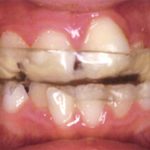 È davvero superato il ruolo dell’occlusione nella patogenesi del bruxismo? La sindrome occlusale