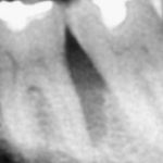 Trattamento di un difetto parodontale infraosseo con beta-fosfato tricalcico: case report