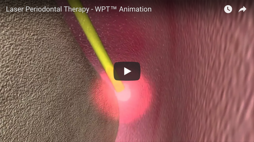 DM_il dentista moderno_Laser in parodontologia