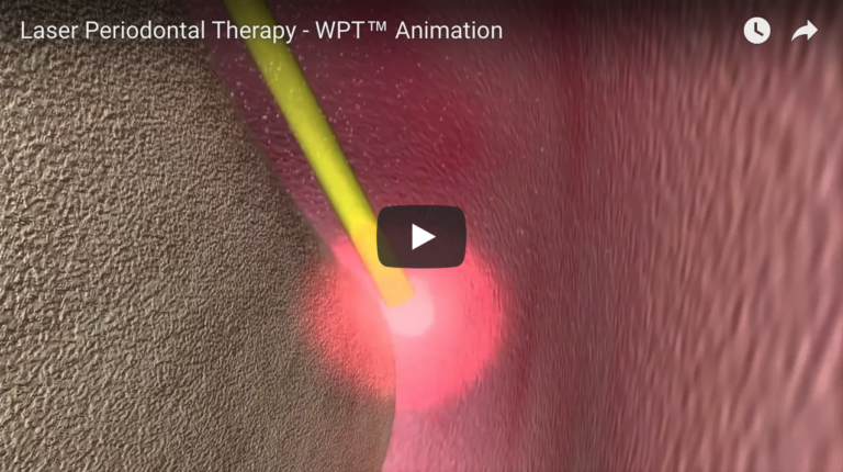 Laser in odontoiatria: analisi della letteratura e prospettive