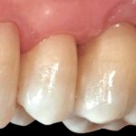 Restauri conservativi di V classe secondo i principi della tecnica BOPT: le risposte tissutali Case report con controllo a 40 mesi