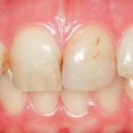 Risoluzione di un caso estetico anteriore con restauri diretti addizionali. Case report